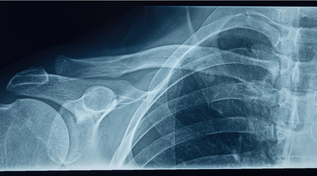 Detailed X-Ray scan of a shoulder area