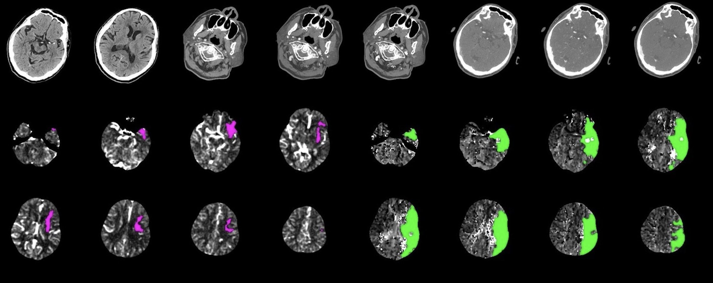 Neuro CTA Image scan